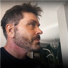Facelift After Photo by Cem Berkay SINACI, MD; Istanbul, M - Case 50949