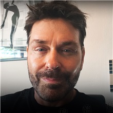Facelift After Photo by Cem Berkay SINACI, MD; Istanbul, M - Case 50949