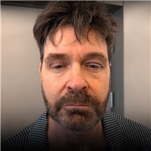 Facelift Before Photo by Cem Berkay SINACI, MD; Istanbul, M - Case 50949