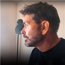 Facelift After Photo by Cem Berkay SINACI, MD; Istanbul, M - Case 50949