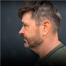 Facelift Before Photo by Cem Berkay SINACI, MD; Istanbul, M - Case 50949