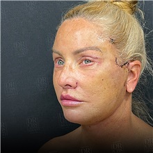 Facelift After Photo by Cem Berkay SINACI, MD; Istanbul, M - Case 50951