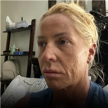 Facelift Before Photo by Cem Berkay SINACI, MD; Istanbul, M - Case 50951