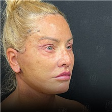 Facelift After Photo by Cem Berkay SINACI, MD; Istanbul, M - Case 50951