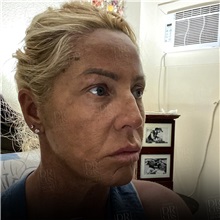Facelift Before Photo by Cem Berkay SINACI, MD; Istanbul, M - Case 50951