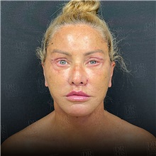 Facelift After Photo by Cem Berkay SINACI, MD; Istanbul, M - Case 50951