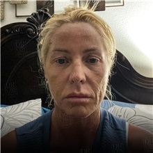 Facelift Before Photo by Cem Berkay SINACI, MD; Istanbul, M - Case 50951