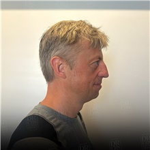 Facelift Before Photo by Cem Berkay SINACI, MD; Istanbul, M - Case 50953