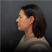Facelift After Photo by Cem Berkay SINACI, MD; Istanbul, M - Case 50952