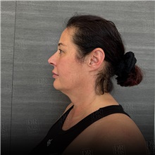 Facelift Before Photo by Cem Berkay SINACI, MD; Istanbul, M - Case 50952