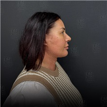 Facelift After Photo by Cem Berkay SINACI, MD; Istanbul, M - Case 50952
