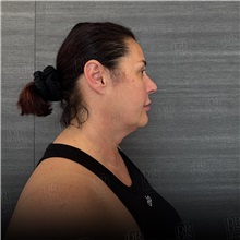 Facelift Before Photo by Cem Berkay SINACI, MD; Istanbul, M - Case 50952
