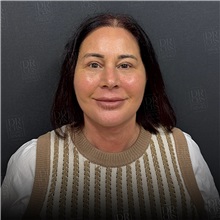 Facelift After Photo by Cem Berkay SINACI, MD; Istanbul, M - Case 50952