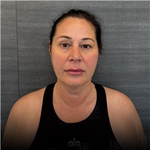 Facelift Before Photo by Cem Berkay SINACI, MD; Istanbul, M - Case 50952
