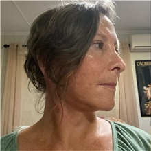 Facelift After Photo by Cem Berkay SINACI, MD; Istanbul, M - Case 50954