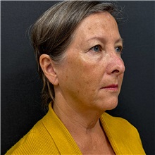 Facelift Before Photo by Cem Berkay SINACI, MD; Istanbul, M - Case 50954