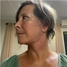 Facelift After Photo by Cem Berkay SINACI, MD; Istanbul, M - Case 50954