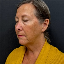 Facelift Before Photo by Cem Berkay SINACI, MD; Istanbul, M - Case 50954