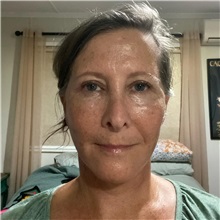 Facelift After Photo by Cem Berkay SINACI, MD; Istanbul, M - Case 50954