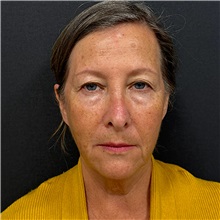 Facelift Before Photo by Cem Berkay SINACI, MD; Istanbul, M - Case 50954