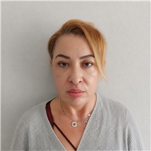 Facelift After Photo by Cem Berkay SINACI, MD; Istanbul, M - Case 50956