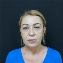 Facelift Before Photo by Cem Berkay SINACI, MD; Istanbul, M - Case 50956