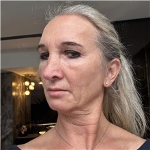 Facelift Before Photo by Cem Berkay SINACI, MD; Istanbul, M - Case 50963