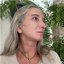 Facelift After Photo by Cem Berkay SINACI, MD; Istanbul, M - Case 50963