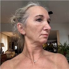 Facelift Before Photo by Cem Berkay SINACI, MD; Istanbul, M - Case 50963