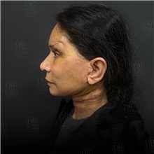 Facelift After Photo by Cem Berkay SINACI, MD; Istanbul, M - Case 50964