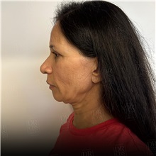 Facelift Before Photo by Cem Berkay SINACI, MD; Istanbul, M - Case 50964