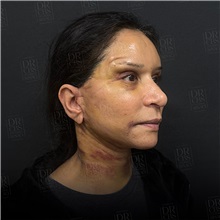 Facelift After Photo by Cem Berkay SINACI, MD; Istanbul, M - Case 50964