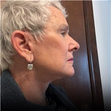 Facelift After Photo by Cem Berkay SINACI, MD; Istanbul, M - Case 50965