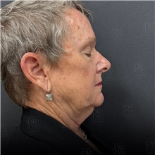 Facelift Before Photo by Cem Berkay SINACI, MD; Istanbul, M - Case 50965