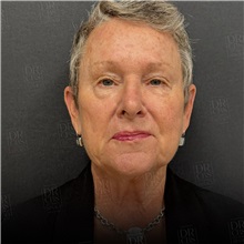 Facelift Before Photo by Cem Berkay SINACI, MD; Istanbul, M - Case 50965