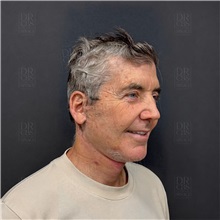 Facelift After Photo by Cem Berkay SINACI, MD; Istanbul, M - Case 50968