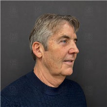 Facelift Before Photo by Cem Berkay SINACI, MD; Istanbul, M - Case 50968