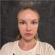 Facelift After Photo by Cem Berkay SINACI, MD; Istanbul, M - Case 50969