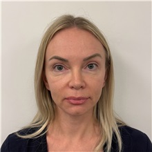 Facelift Before Photo by Cem Berkay SINACI, MD; Istanbul, M - Case 50969