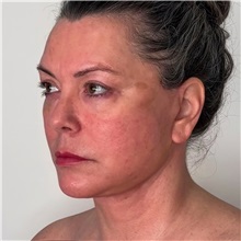 Facelift After Photo by Cem Berkay SINACI, MD; Istanbul, M - Case 50973