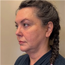 Facelift Before Photo by Cem Berkay SINACI, MD; Istanbul, M - Case 50973