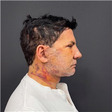 Facelift After Photo by Cem Berkay SINACI, MD; Istanbul, M - Case 50971