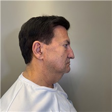 Facelift Before Photo by Cem Berkay SINACI, MD; Istanbul, M - Case 50971