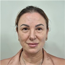 Facelift Before Photo by Cem Berkay SINACI, MD; Istanbul, M - Case 50988