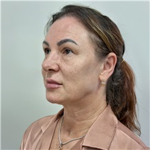 Facelift Before Photo by Cem Berkay SINACI, MD; Istanbul, M - Case 50988