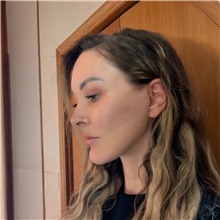Facelift After Photo by Cem Berkay SINACI, MD; Istanbul, M - Case 50985