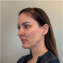 Facelift Before Photo by Cem Berkay SINACI, MD; Istanbul, M - Case 50985