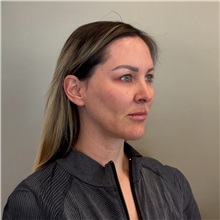 Facelift Before Photo by Cem Berkay SINACI, MD; Istanbul, M - Case 50985