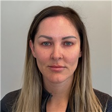 Facelift Before Photo by Cem Berkay SINACI, MD; Istanbul, M - Case 50985