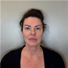 Facelift Before Photo by Cem Berkay SINACI, MD; Istanbul, M - Case 50987